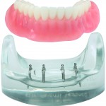 Mini Implantate Unterkieferprothese 150x150